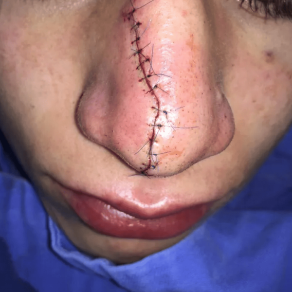 Manejo de heridas en cara