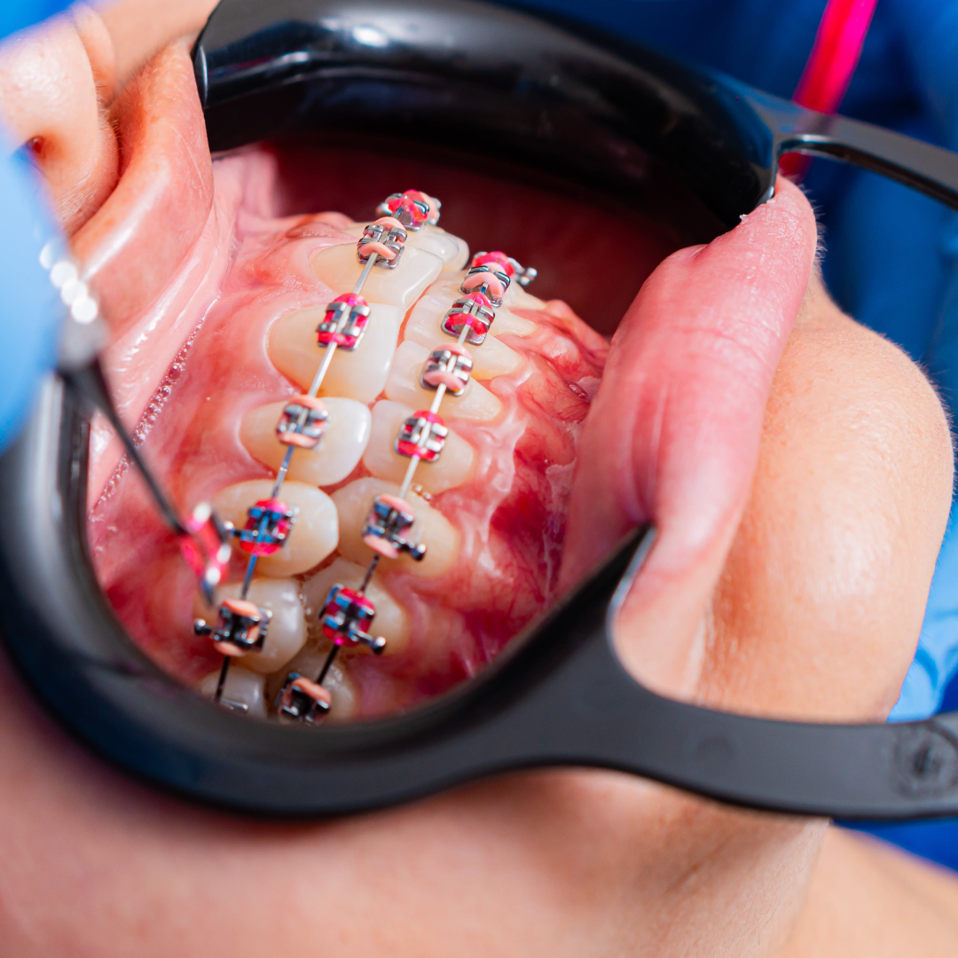 Ortodoncia Brackets Autoligado Metalicos Oris Odontolog a
